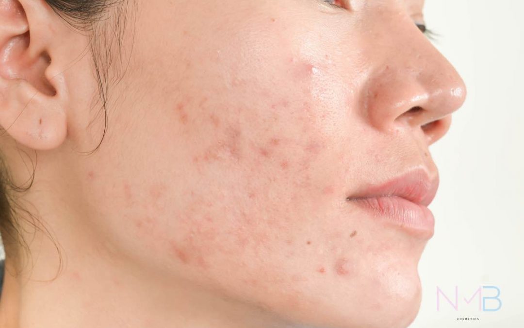 Rostro de una mujer con acné