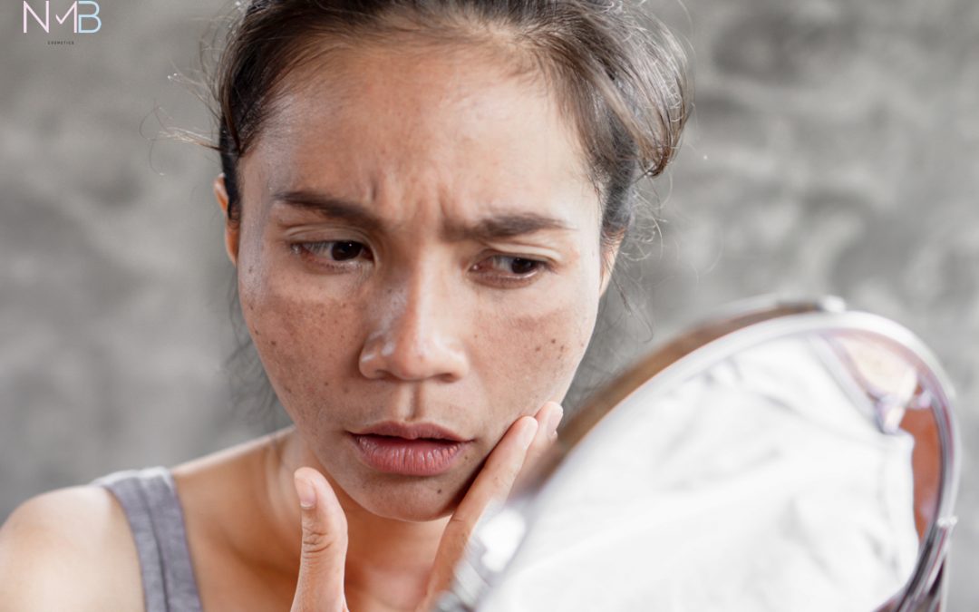 Blanqueamiento facial para tratar la hiperpigmentación